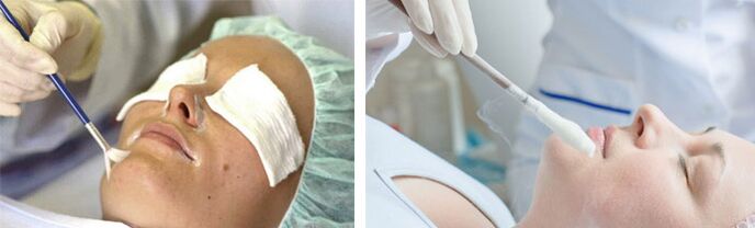Peeling et cryothérapie pour le rajeunissement de la peau. 