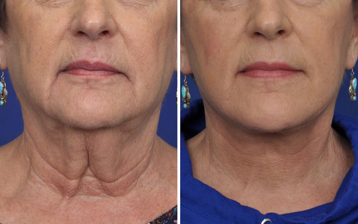 avant et après les procédures de rajeunissement de la peau