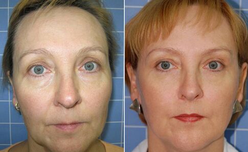 Avant et après le rajeunissement du visage fractionné au laser