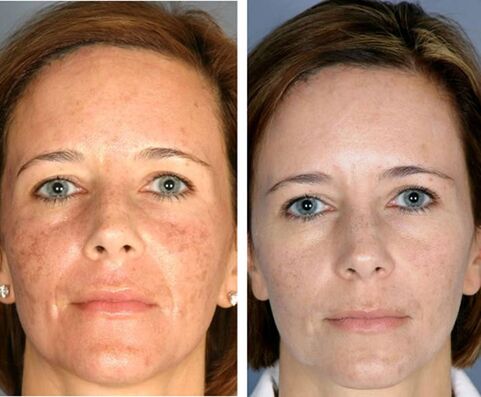 Avant et après thermolyse faciale fractionnée. 