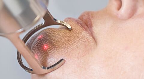 Le déroulement de la procédure de rajeunissement fractionné de la peau du visage au laser. 