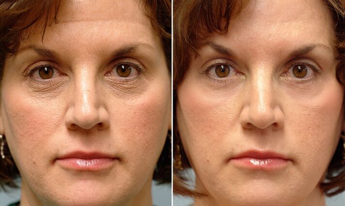 visage avant et après le resurfaçage au laser fractionné