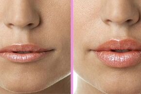 avant et après la procédure de restauration des lèvres